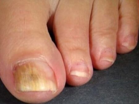 Fungo das uñas