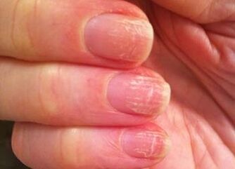 A fase inicial do cogomelo nas uñas