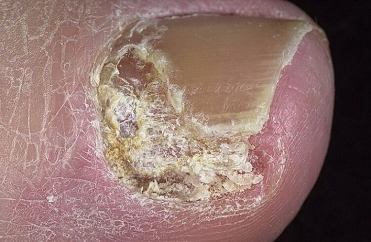 Tipos de onicomicosis