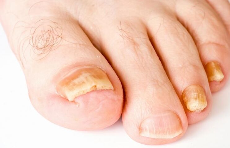 Unhas amarelas dos pés por fungo