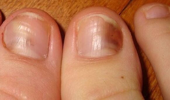 Unhas afectadas por fungos