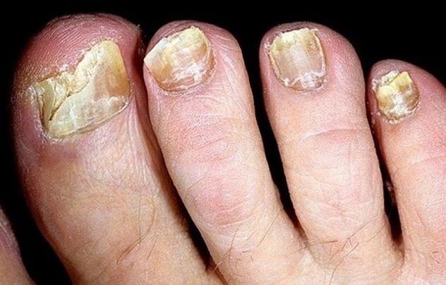 Fungo nas unhas dos pés