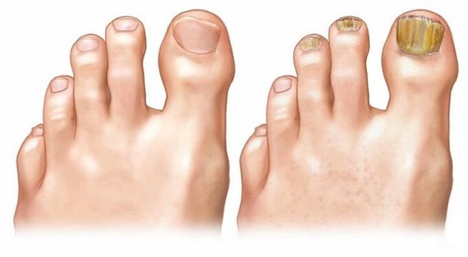 unhas saudables e fungos das unhas dos pés